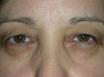 Lower Eyelid Blepharoplasty