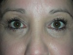 Lower Eyelid Blepharoplasty