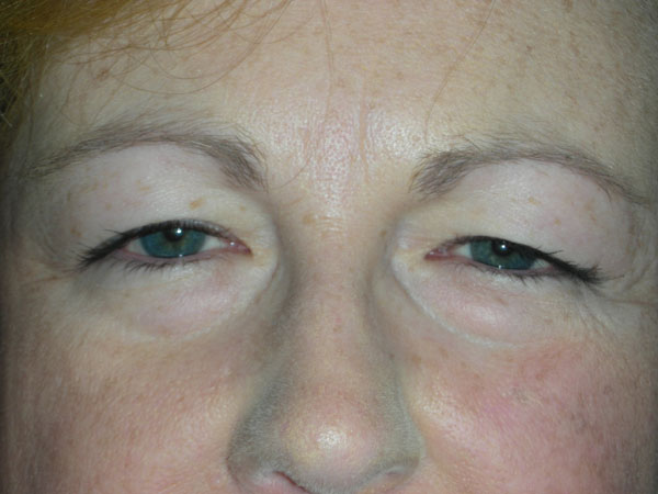 Lower Eyelid Blepharoplasty