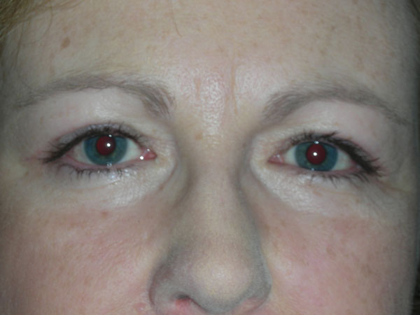 Lower Eyelid Blepharoplasty