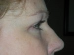 Lower Eyelid Blepharoplasty