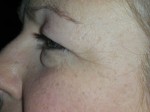 Lower Eyelid Blepharoplasty