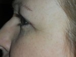 Lower Eyelid Blepharoplasty