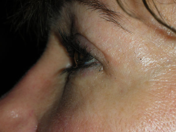 Lower Eyelid Blepharoplasty