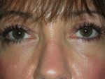 Lower Eyelid Blepharoplasty