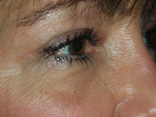 Lower Eyelid Blepharoplasty