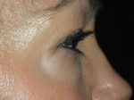 Lower Eyelid Blepharoplasty