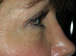 Lower Eyelid Blepharoplasty