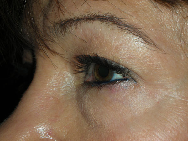 Lower Eyelid Blepharoplasty