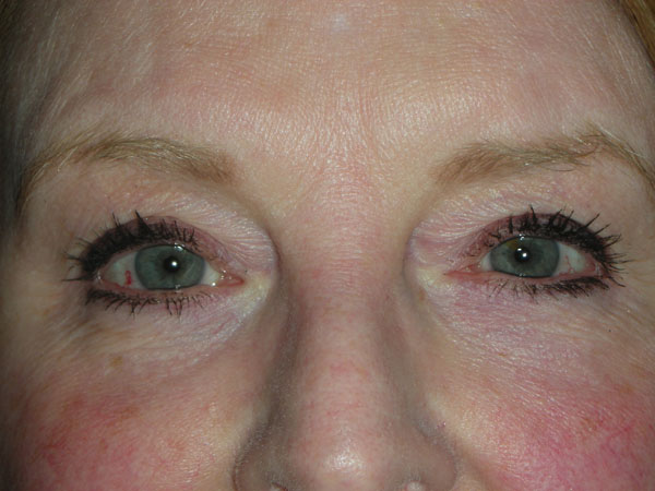 Lower Eyelid Blepharoplasty