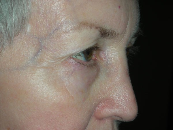 Lower Eyelid Blepharoplasty