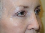 Lower Eyelid Blepharoplasty