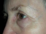 Lower Eyelid Blepharoplasty