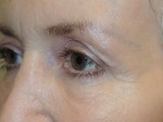 Lower Eyelid Blepharoplasty