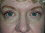 Cosmetic Upper Eyelid Blepharoplasty