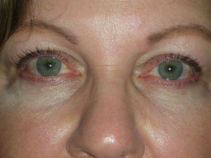 Cosmetic Upper Eyelid Blepharoplasty