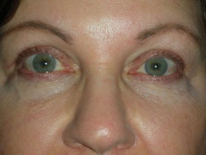 Cosmetic Upper Eyelid Blepharoplasty