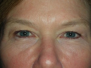 Cosmetic Upper Eyelid Blepharoplasty