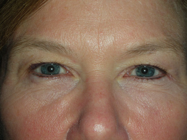 Cosmetic Upper Eyelid Blepharoplasty