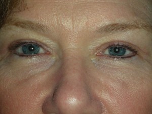Cosmetic Upper Eyelid Blepharoplasty