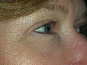 Cosmetic Upper Eyelid Blepharoplasty