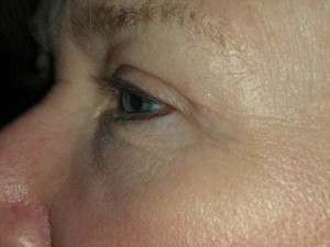 Cosmetic Upper Eyelid Blepharoplasty