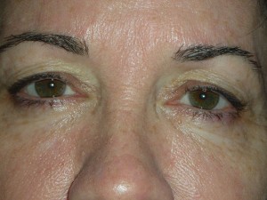 Cosmetic Upper Eyelid Blepharoplasty