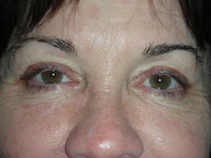 Cosmetic Upper Eyelid Blepharoplasty