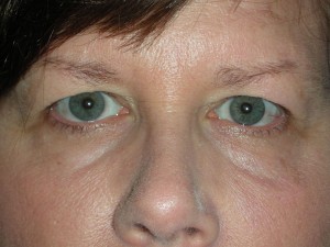 Cosmetic Upper Eyelid Blepharoplasty