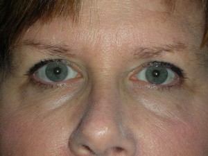 Cosmetic Upper Eyelid Blepharoplasty