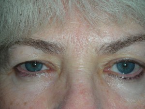 Cosmetic Upper Eyelid Blepharoplasty