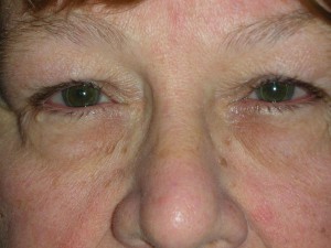 Cosmetic Upper Eyelid Blepharoplasty
