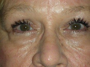 Cosmetic Upper Eyelid Blepharoplasty