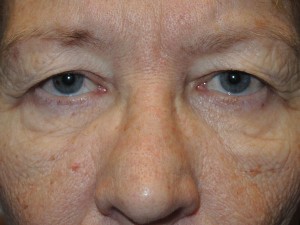 Cosmetic Upper Eyelid Blepharoplasty