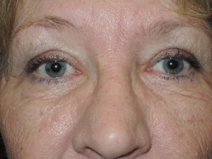 Cosmetic Upper Eyelid Blepharoplasty