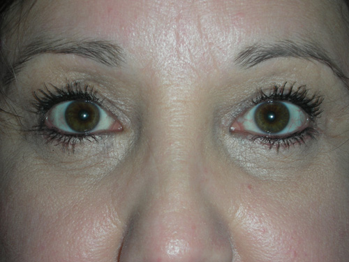 Cosmetic Ptosis Repair