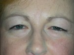 Cosmetic Ptosis Repair