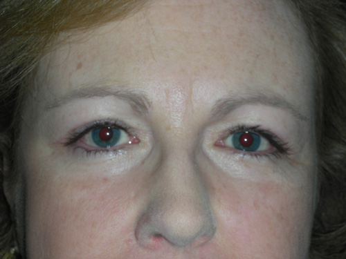 Cosmetic Ptosis Repair