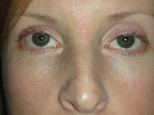 Cosmetic Ptosis Repair