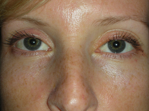 Cosmetic Ptosis Repair