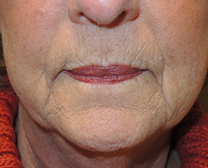 Laser Resurfacing