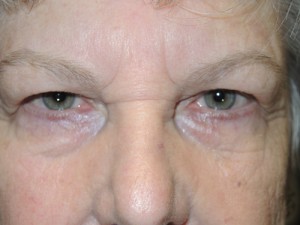 Cosmetic Upper Eyelid Blepharoplasty