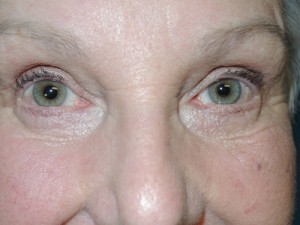 Cosmetic Upper Eyelid Blepharoplasty