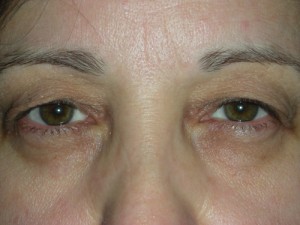 Cosmetic Upper Eyelid Blepharoplasty
