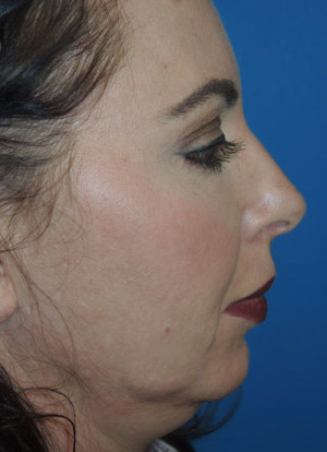 Facelift