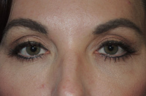 Cosmetic Upper Eyelid Blepharoplasty
