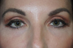 Cosmetic Upper Eyelid Blepharoplasty