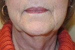 Laser Resurfacing