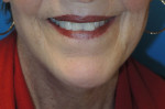 Laser Resurfacing