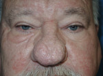 Rhinophyma